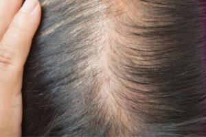 अगर आप पतलेपन से परेशान हैं तो इन घरेलू उपायों को अपनाएं