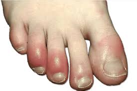 सर्दियों में आ जाती है हाथ पैरों में सूजन तो अपनाएं ये घरेलू उपाय सर्दियों में आ जाती है हाथ पैरों में सूजन तो अपनाएं ये घरेलू उपाय