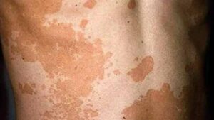 हृदय रोग, लकवा, सफेद दाग, दमा, लीवर रोग, हकलाहट, नपुंसकता सभी का ईलाज है यह पत्ता