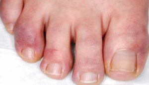 सर्दियों में आ जाती है हाथ पैरों में सूजन तो अपनाएं ये घरेलू उपाय सर्दियों में आ जाती है हाथ पैरों में सूजन तो अपनाएं ये घरेलू उपाय