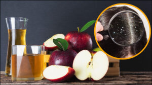 डैंड्रफ की छुट्टी कर देगा सेब का सिरका, जानिए कैसे