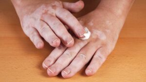 हृदय रोग, लकवा, सफेद दाग, दमा, लीवर रोग, हकलाहट, नपुंसकता सभी का ईलाज है यह पत्ता