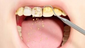 पीले दांतों को दूध जैसा सफेद कर देगा ये सबसे आसान घरेलू उपाय, अवश्य प्रयोग करें