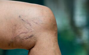 ब्लॉक नसों को खोल देता है यह घरेलू रामबाण एक बार जरूर जान लें