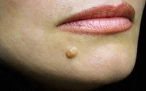 शरीर के मस्से को जड़ से ख़त्म करने के लिए करे ये उपाय